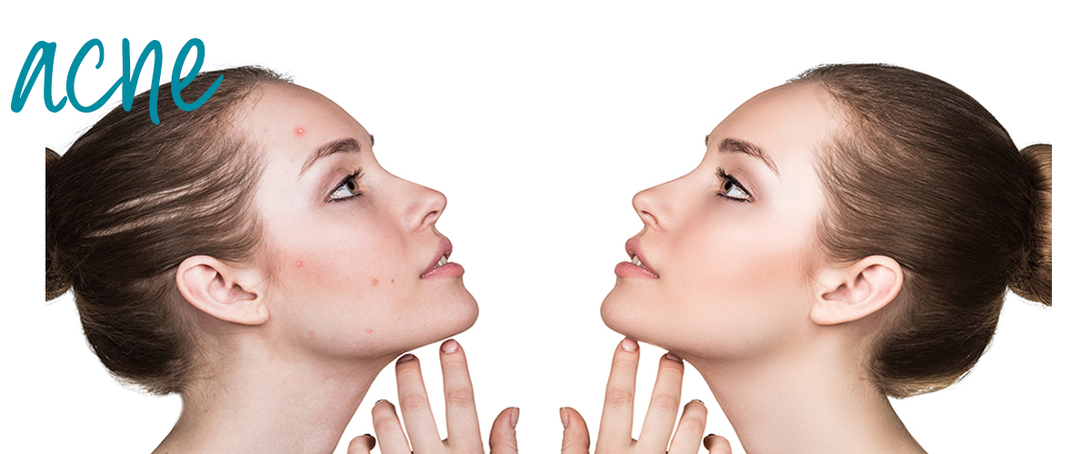 woman looking at herself one with clear skin and one with acne