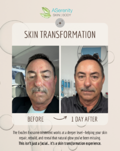 exozen exosome facial at ASerenity