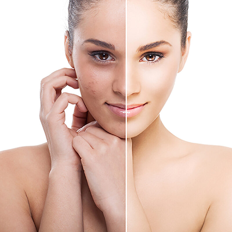woman face half clear and half with acne